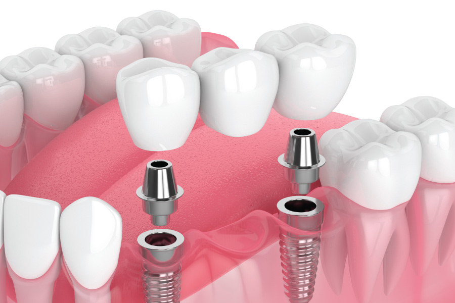 Everett Implant-Supported Bridges