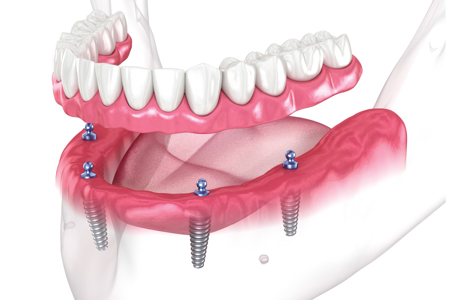 Everett Implant-Supported Dentures