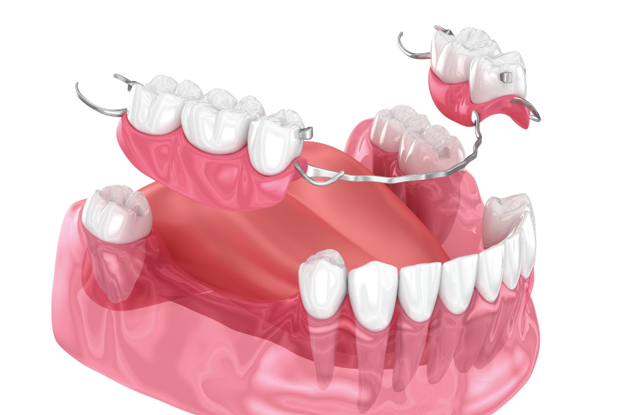 Everett Partial Dentures